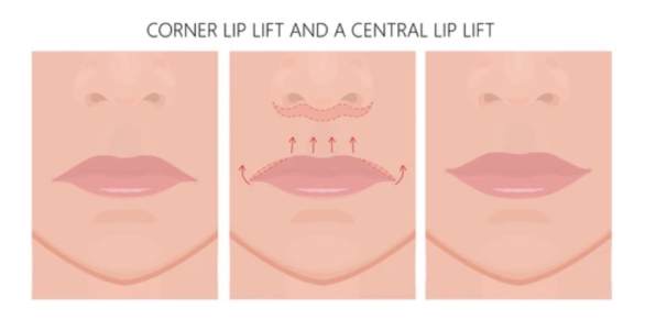 Apakah Operasi Pengencangan Bibir Dapat Mengubah Senyum? Fakta Medisnya Seputar Lip Lift