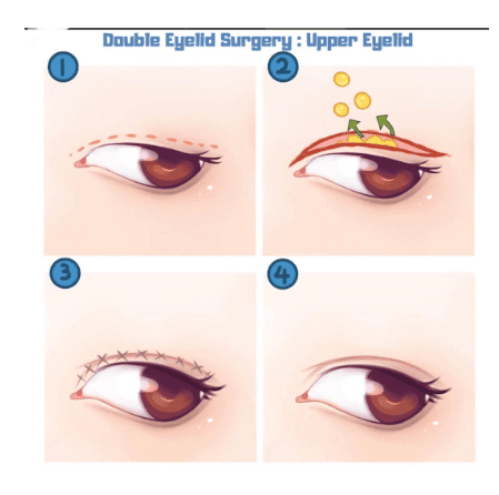 Cara Tepat Merawat Kelopak Mata Pasca Blepharoplasty Atas. Ketahui Rahasianya!