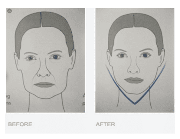 Wajah Tampak Langsing & Awet Muda dengan Facelift
