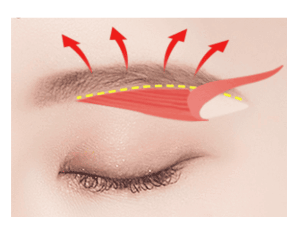 Mata Sayu Kembali Segar dengan Operasi Pengencangan Sub Alis (Sub-Brow Lift)