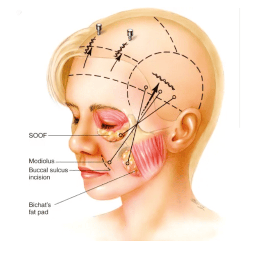 Manfaat Facelift Endoskopi: Rahasia Wajah Kencang dengan Minim Bekas Luka