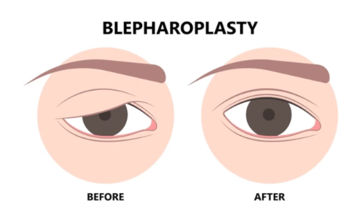 Mengenal Blepharoplasty: Jenis Operasi Pengencangan Kelopak Mata Berkerudung